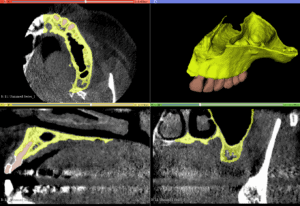 CBCT and Segmentation